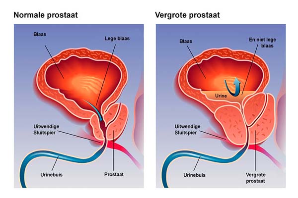Read more about the article SVZ wil meer doen aan bestrijding prostaatkanker