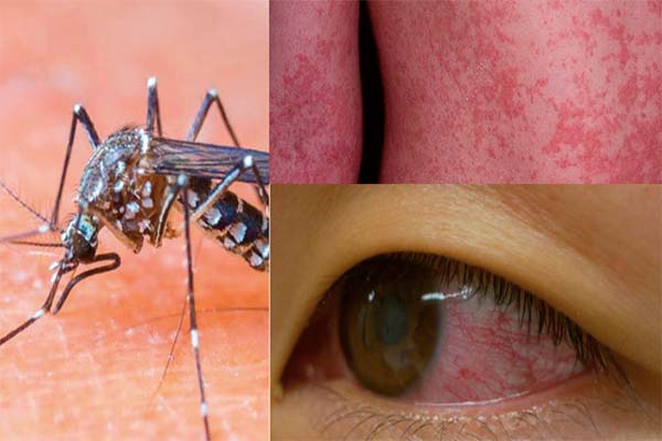 Read more about the article Zika-virus steekt kop op in Guyana