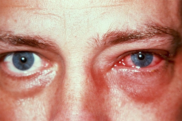 Read more about the article Tekort oogdruppels niet fataal voor oogviruspatiënten