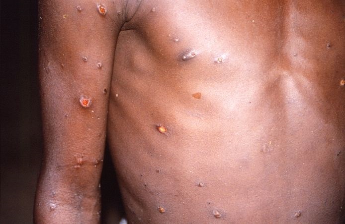 monkeypox apenpokken virus ziekte