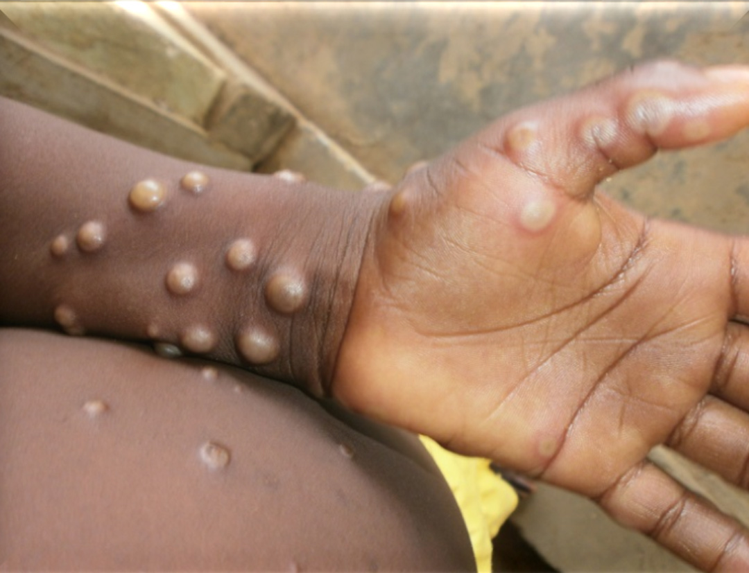 Read more about the article WHO prekwalificeert eerste vaccin tegen mpox